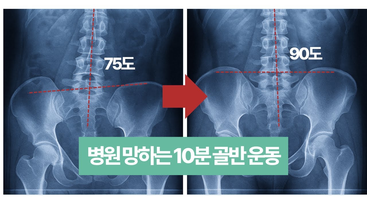 골반 틀어진 사람 99%가 ‘이것’을 안 합니다