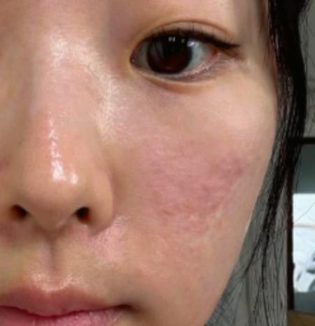 다들 보니까 추어져서 요철 올라올 시즌 맞나봄 ㅋㅋㅋ 나도 그랬는뎈ㅋㅋ 방법 알려줌!(+전후사진 이씀)