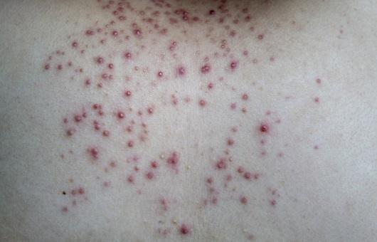 온몸에 여드름같은게 생겼는데 빨간색으로 뭘까 이거