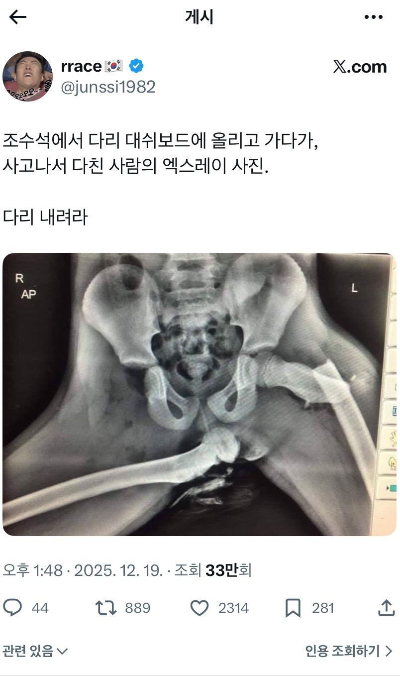조수석에 다리 올리고 가다가 사고난 사람의 엑스레이 사진