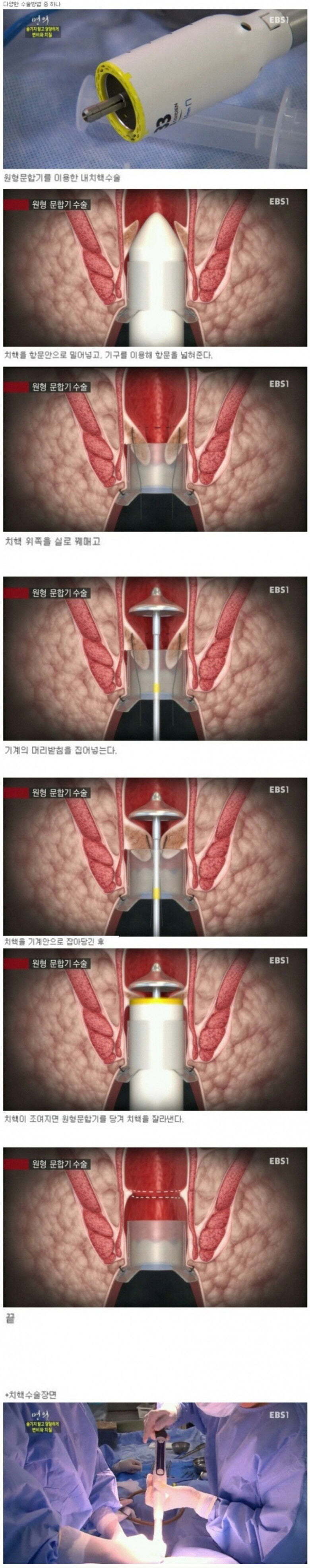 IMG_0983.jpeg 치질 수술 기계.jpg