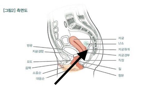 17655a1bdc14fb8cc.jpeg 자궁까지 삽입이 안 되는 이유...jpg