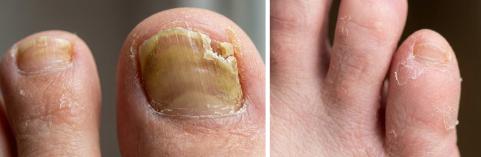 [정보/스압] 신발 벗기 두려운 분들을 위한 무좀 교과서.txt 2번째 사진