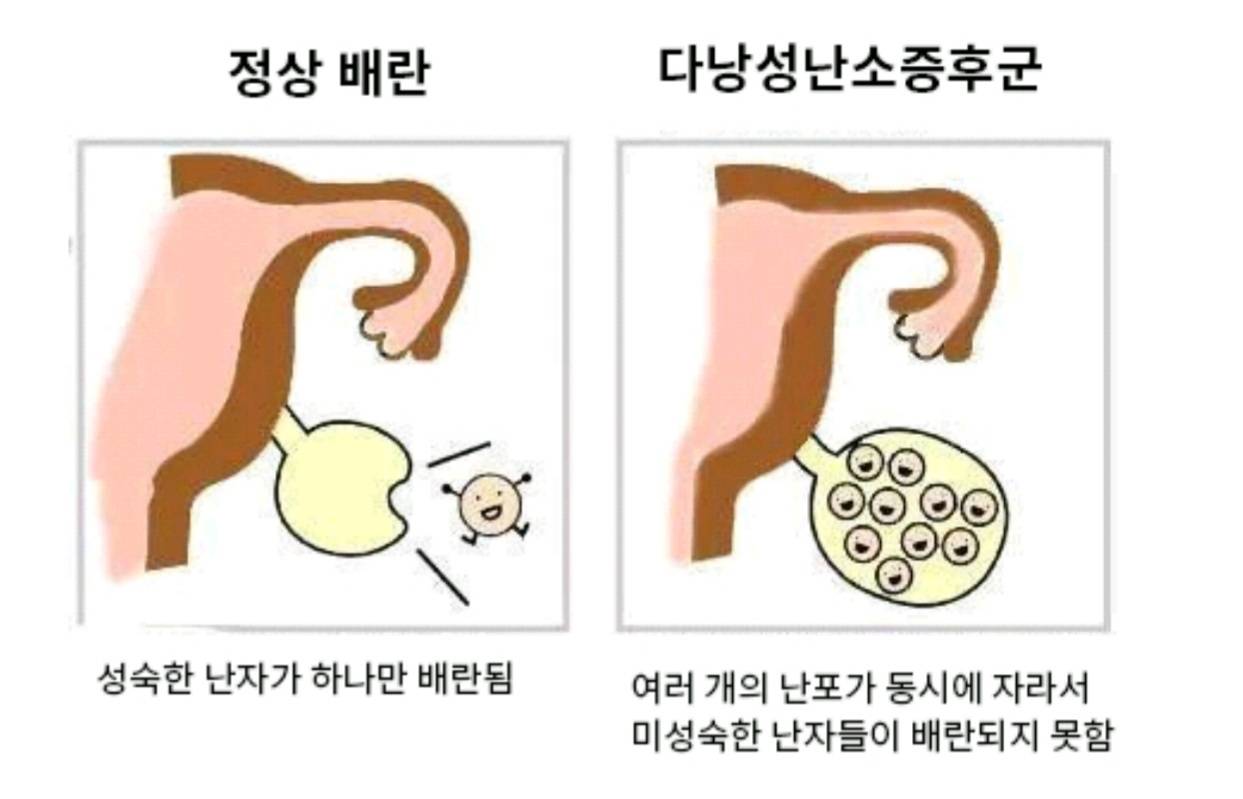 안 유명한데 흔한 여성 질병 ㅡ다낭성난소증후군 | 인스티즈