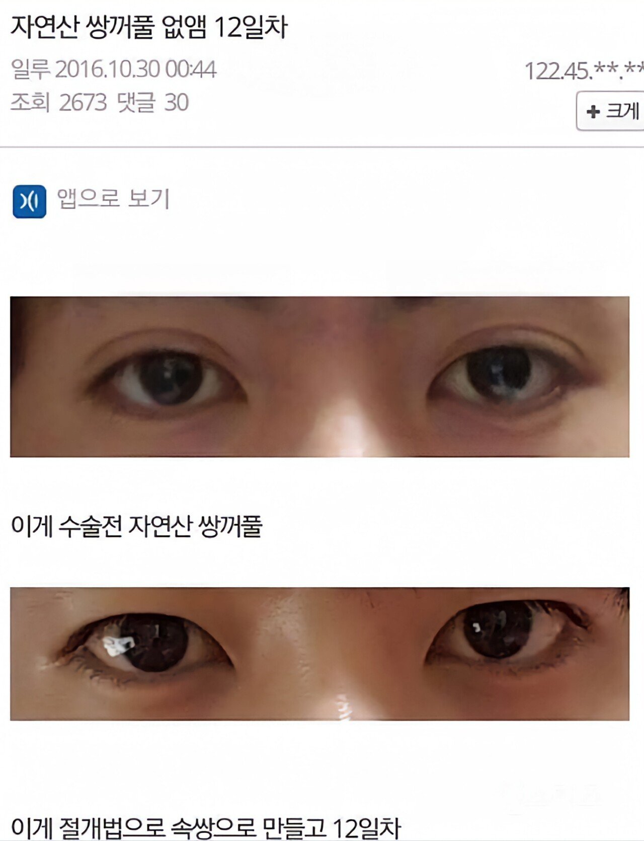 무쌍 수술.jpg