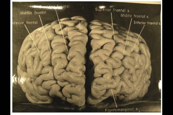 5.jpg 미국 박물관에 전시된 아인슈타인의 뇌