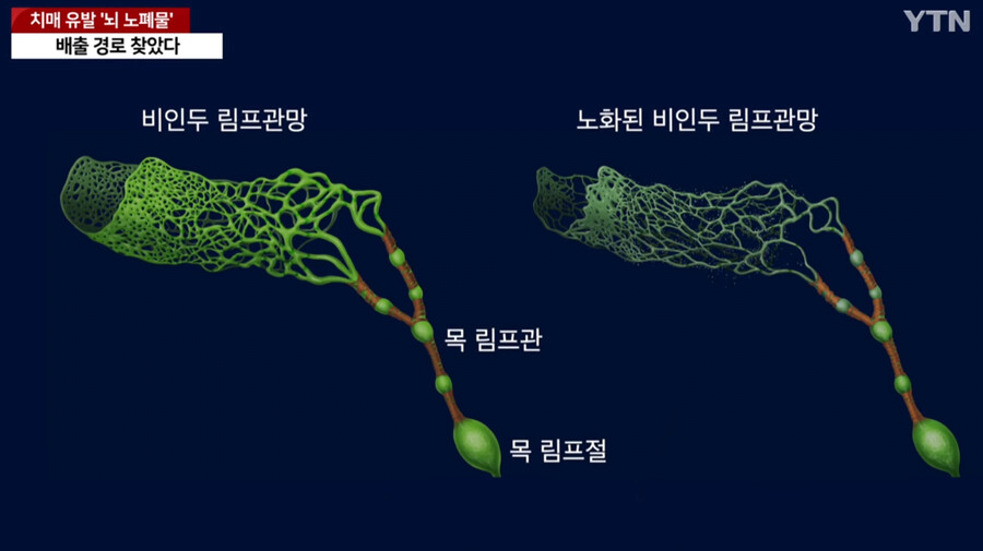 image.png 국내에서 세계최초로 "치매 유발 뇌 노폐물 배출 경로" 찾았다