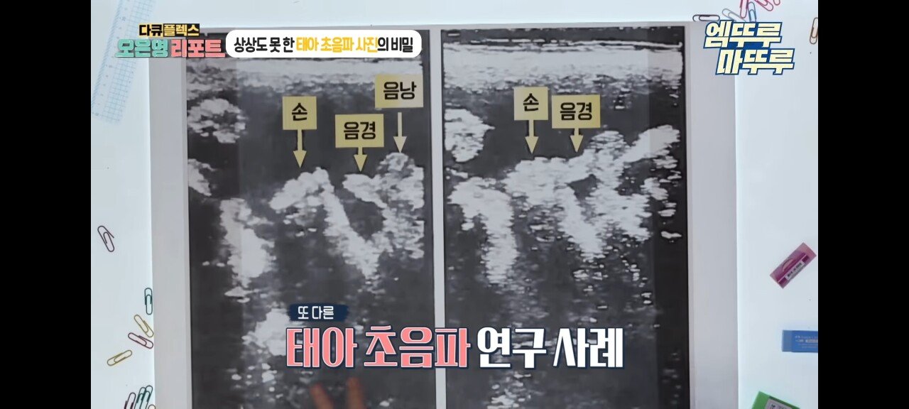 신기한 태아 발기 태아도 발기를 하는구나