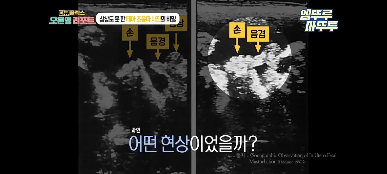 신기한 태아 발기 태아도 발기를 하는구나