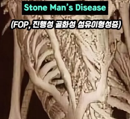 근육과 힘줄이 뼈로 변하는 질병.jpg