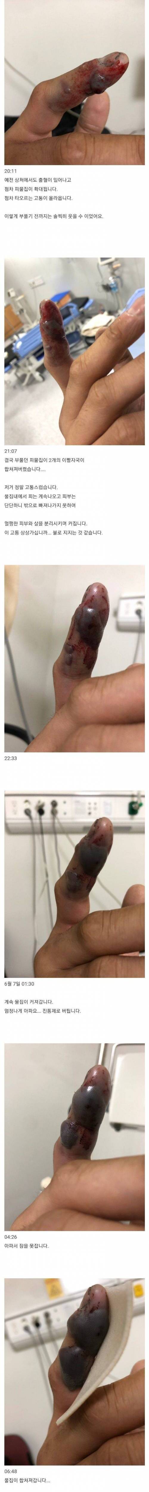 IMG_4999.jpeg 약혐) 쇠살모사에 물린 사람