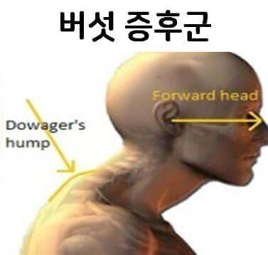 image.png 거북목이 극한까지 가면 벌어지는 일