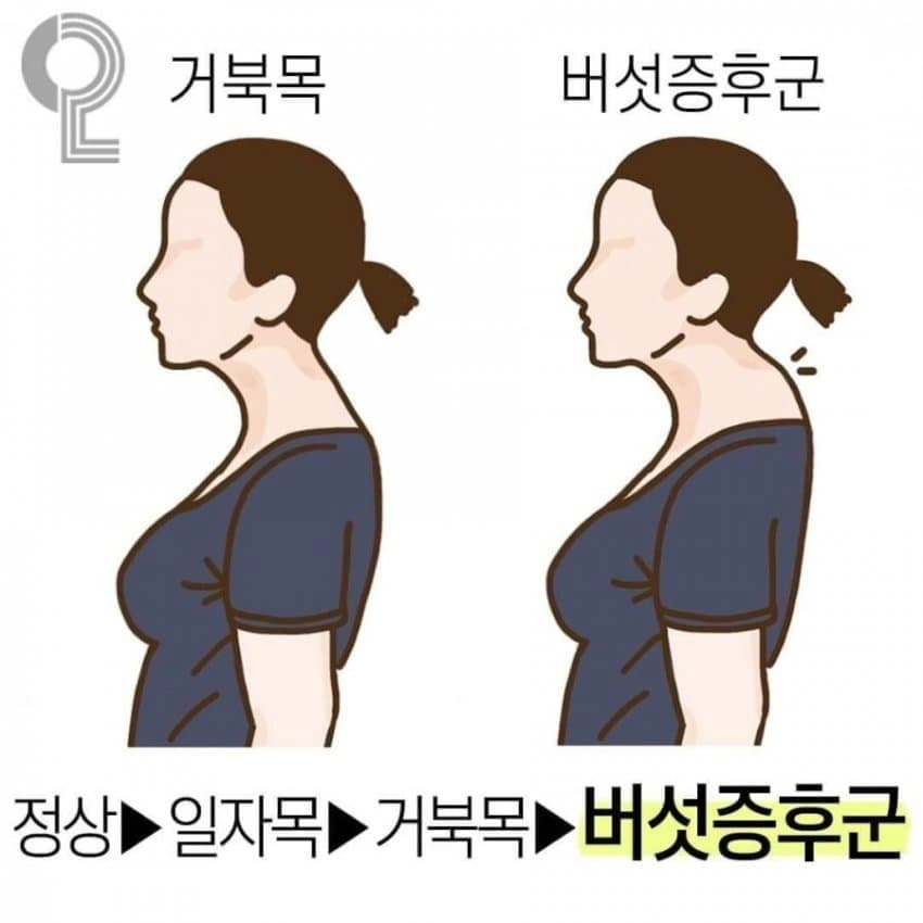image.png 거북목이 극한까지 가면 벌어지는 일